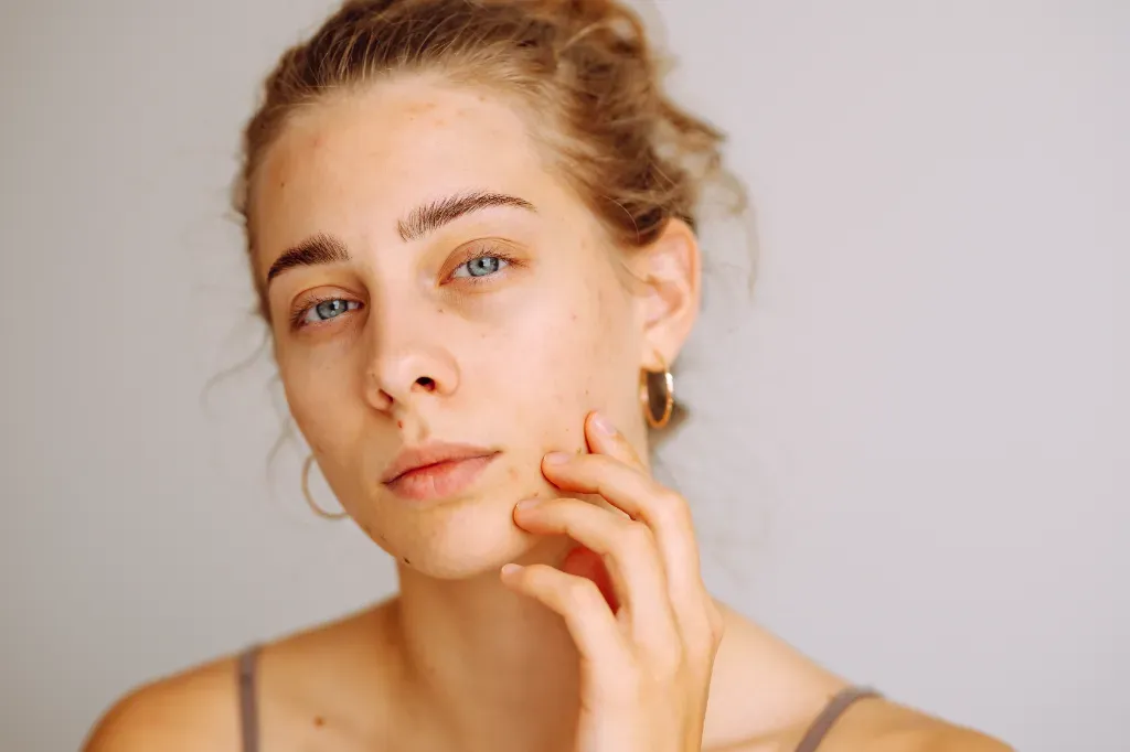 Łojotokowe zapalenia skóry